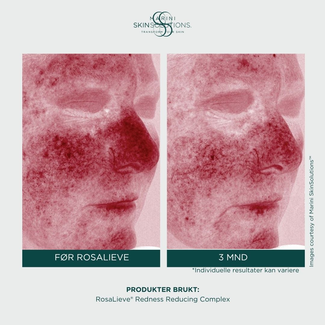 Jan Marini - Rosalieve Redness Reducing Complex (30ml)