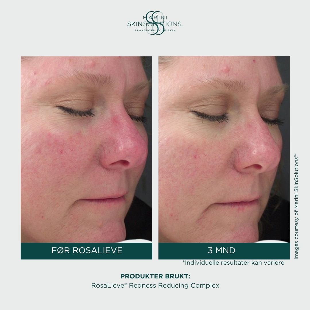 Jan Marini - Rosalieve Redness Reducing Complex (30ml)